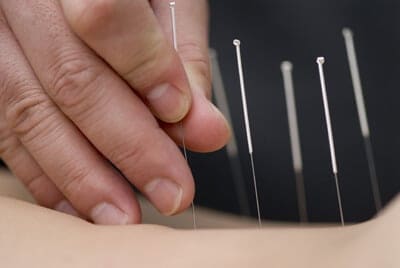 acupuncture